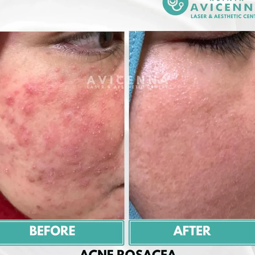 klinik avicenna jitra skin eczema aesthetic acne acne scar pigmentation hair laser