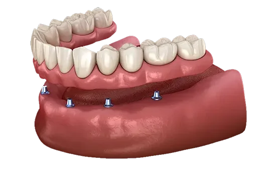 klinik pergigian dr g mersing implantdenturebraceslaser